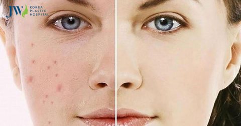 Cách trị thâm mụn hiệu quả cấp tốc tại nhà đọc ngay để tiết kiệm chi phí