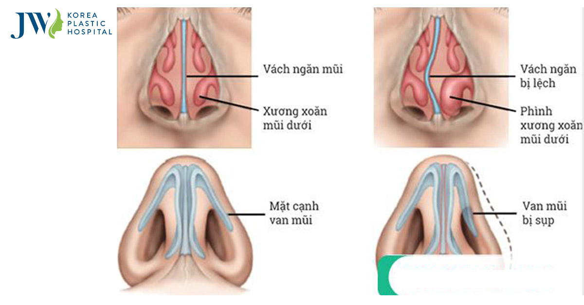 Mũi lệch, vẹo vách ngăn khi nào thì cần mổ để chỉnh lại dáng mũi?