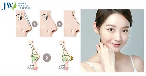 Nâng mũi bằng sụn vách ngăn sở hữu chiếc mũi đẹp an toàn 100%