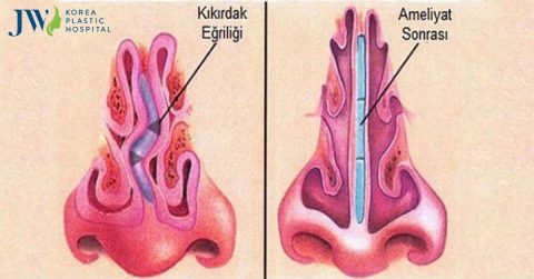 Vẹo vách ngăn mũi có ảnh hưởng nghiêm trọng đến sức khỏe không?