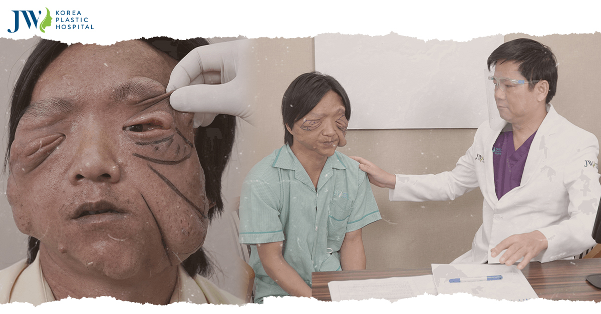 Bệnh viện JW phẫu thuật thành công u sợi thần kinh cho Pu