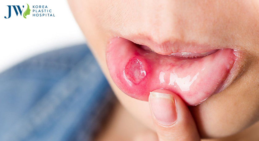 Một số chất trong kem đánh răng sẽ làm lở loét miệng diện rộng