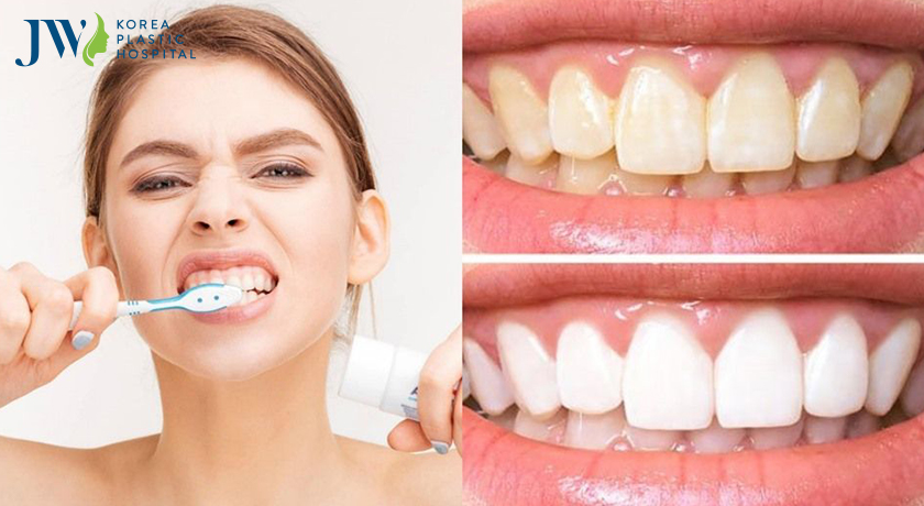Sản phẩm đắt tiền chưa chắc làm trắng răng mà ngược lại còn gây hoen ố răng