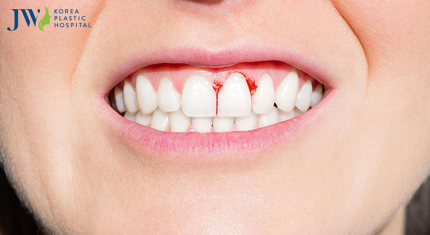 Một số chất làm trắng sử dụng lâu dài lại tổn hại răng và nướu 