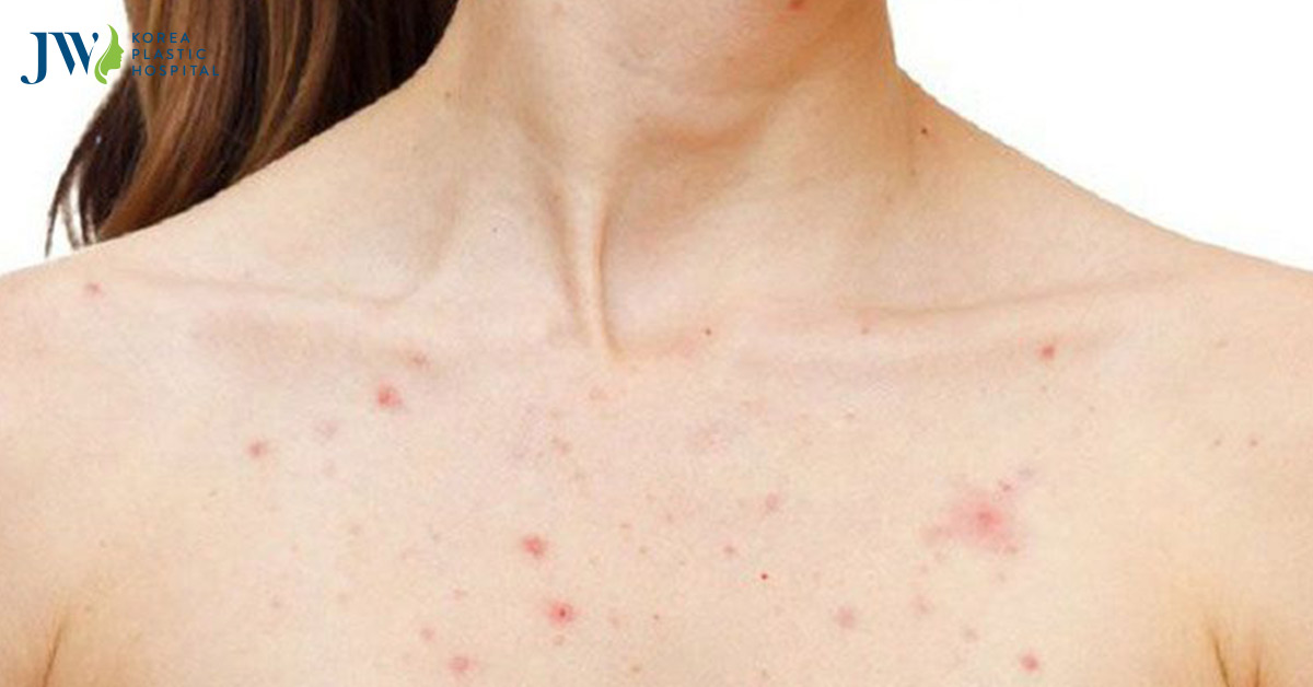Mụn ở ngực cách điều trị tại nhà an toàn và hiệu quả
