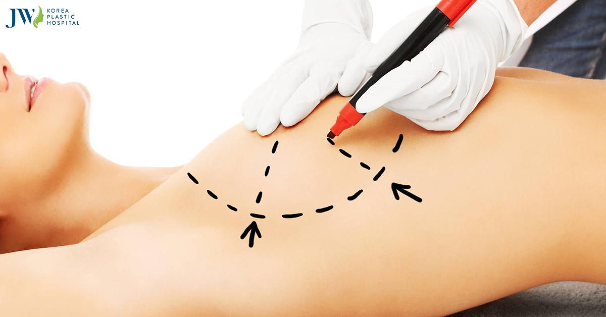 Nâng ngực nội soi đường nách và những điều cần lưu ý khi thực hiện
