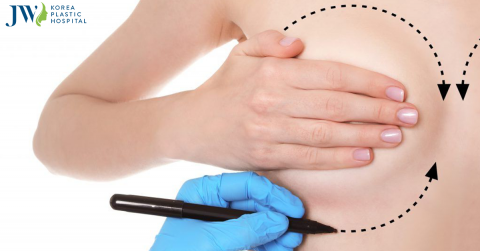 Nâng ngực có nguy hiểm không? Làm gì để hạn chế rủi ro?