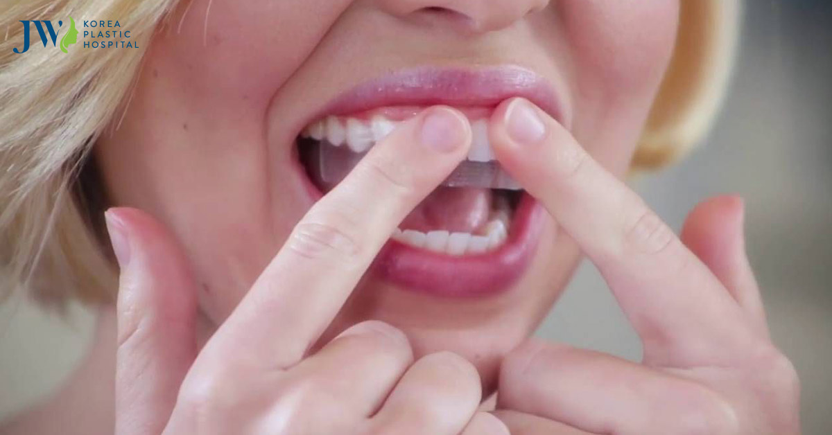 Sự thật miếng dán trắng răng – Liệu có công dụng thần thánh như lời đồn