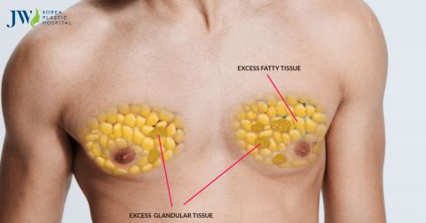 Nâng ngực cho nam giới chuyện lạ có thật tại Việt Nam