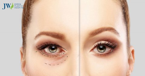 Cắt da thừa mí mắt trên, dưới – Xóa tan dấu vết lão hóa cho đôi mắt
