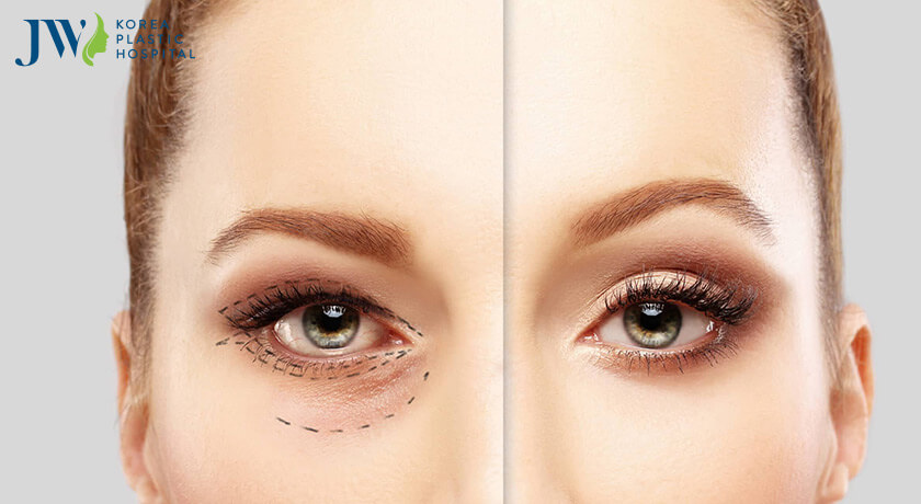 Cắt da thừa mí mắt là giải pháp tốt cho những người bị lão hóa mắt