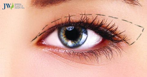 Cắt mí mắt có đau không? Cách giảm đau sau khi cắt mí mắt