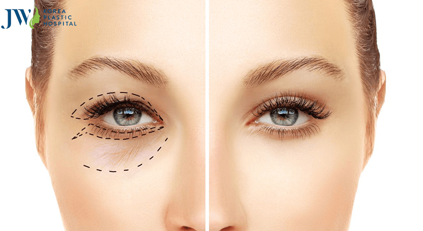 Cắt mí mắt là một lựa chọn hữu hiệu trị chứng mắt một bên một mí, một bên hai mí