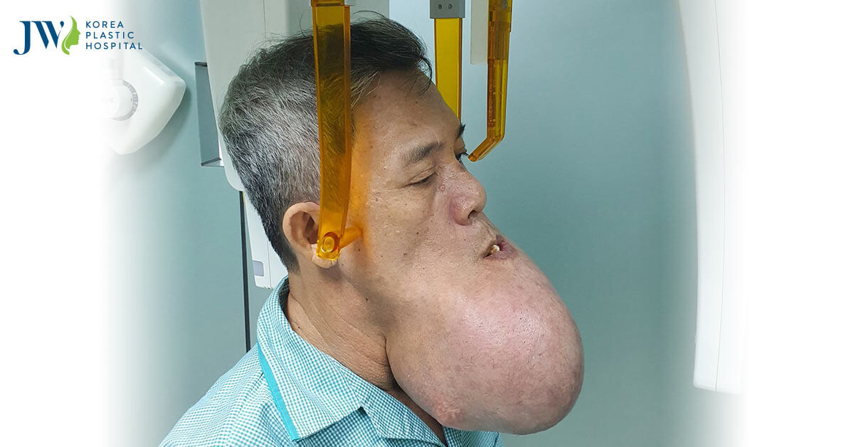 Bác sĩ Tú Dung “bí lối” điều trị cho người đàn ông mặt u khổng lồ