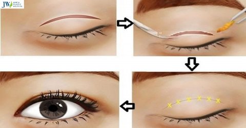 Cắt da thừa mí mắt ở đâu đẹp để trẻ hóa toàn diện đôi mắt