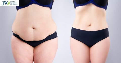 Kinh nghiệm hút mỡ bụng an toàn hiệu quả từ chuyên gia