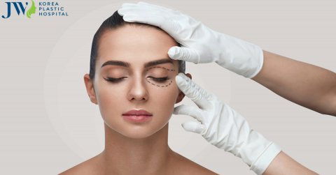 Lấy mỡ mí mắt trên có cần thiết hay không và thực hiện ở đâu uy tín?