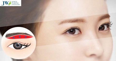 Nâng cung mày bao lâu thì hết sẹo? Bí quyết chăm sóc sau phẫu thuật