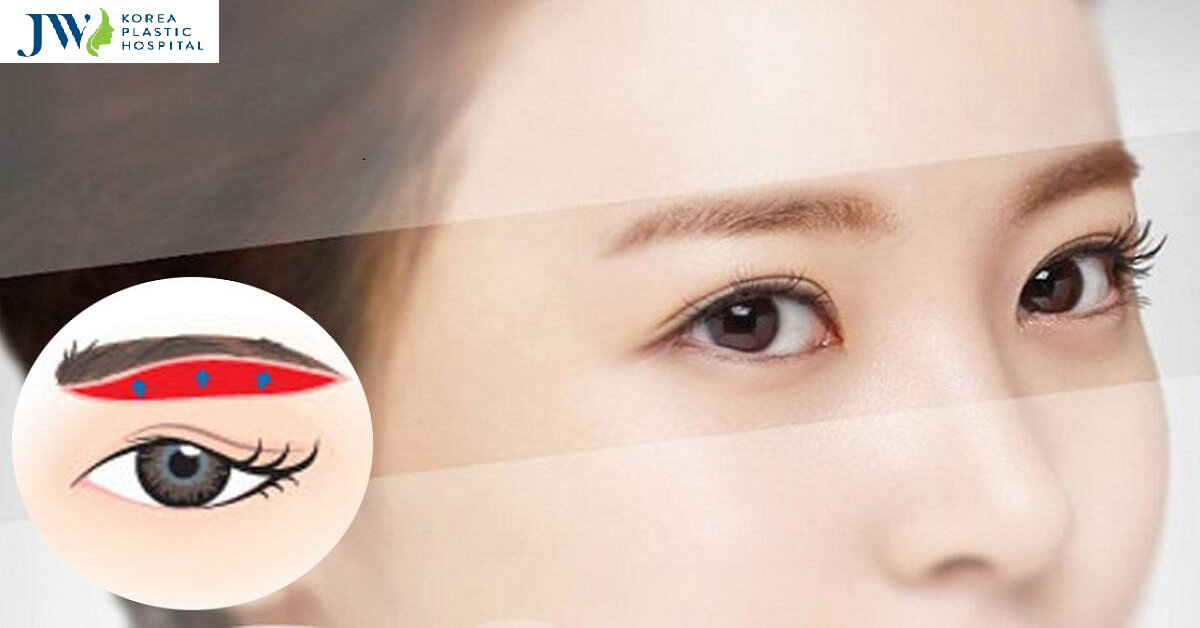 Nâng cung mày bao lâu thì hết sẹo? Bí quyết chăm sóc sau phẫu thuật