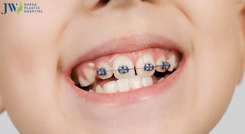 niềng răng từ sớm khắc phục nhanh tình trạng lệch khớp cắn