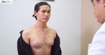 Chi phí phẫu thuật chuyển giới từ nam sang nữ như thế nào?