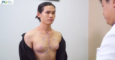 Chi phí phẫu thuật chuyển giới từ nam sang nữ như thế nào?