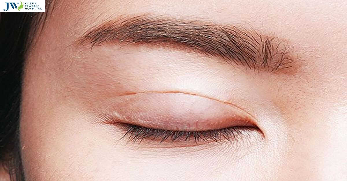 Nhấn mí là gì mà chị em khen làm xong đẹp như sao Hàn