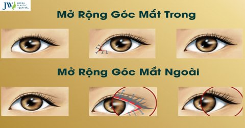 Mở góc mắt trong ngoài có bị sẹo xấu không?