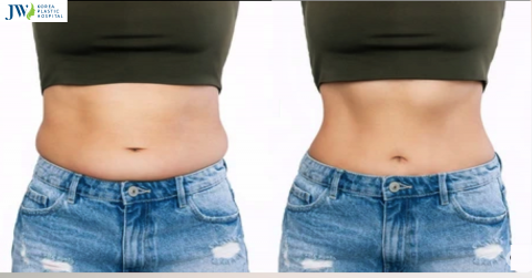 Hút mỡ bụng giá bao nhiêu tiền mới an toàn cho sức khỏe