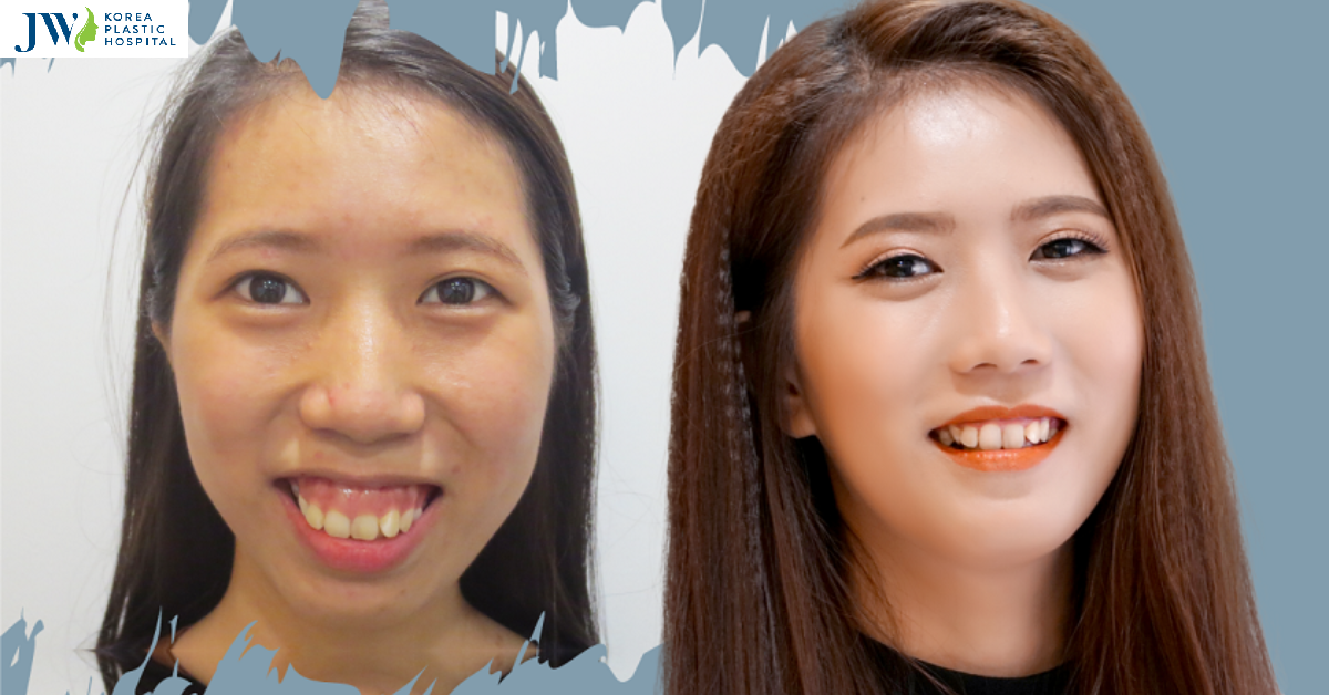 Công nghệ phẫu thuật hàm hô móm toàn diện cải thiện hàm mặt