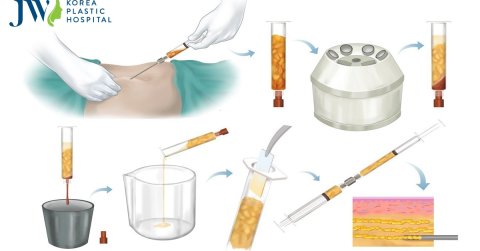 Công nghệ Puregraft chìa khóa cho sự thành công trong cấy ghép mỡ
