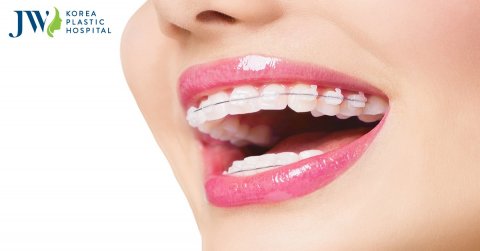Giải đáp thắc mắc sự thật niềng răng có hết hô hàm không?