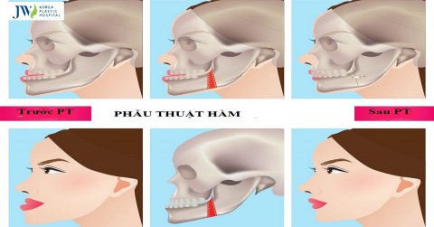Phẫu thuật cắt hàm có để lại di chứng hay không?