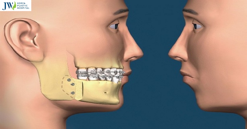 Phẫu thuật răng hô có cải thiện được ngoại hình không