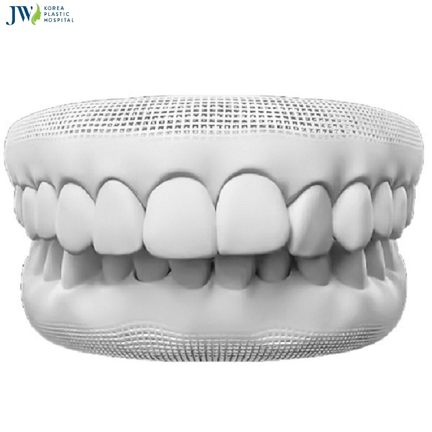 phẫu thuật chỉnh răng hô