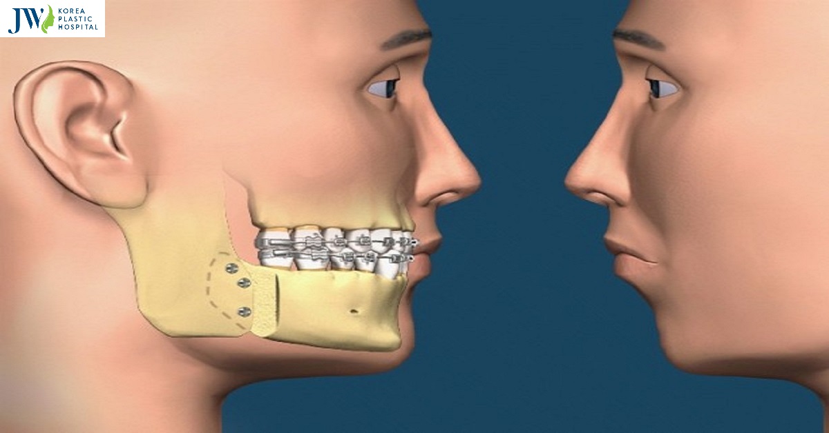 Phẫu thuật răng hô có cải thiện được ngoại hình không?