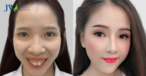 Quy trình phẫu thuật hàm hô đúng chuẩn y khoa tại Bệnh viện JW