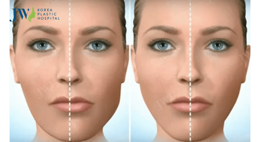 chi phí chỉnh hàm lệch 