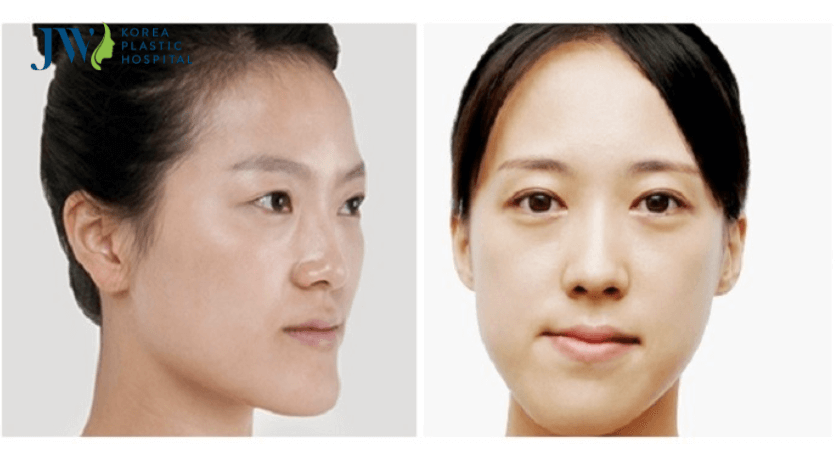 chi phí phẫu thuật hàm lệch