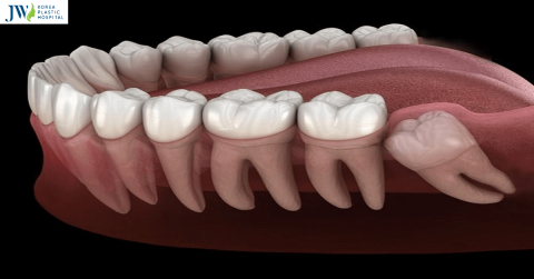 Phẫu thuật răng khôn và những kiến thức cần phải chuẩn bị