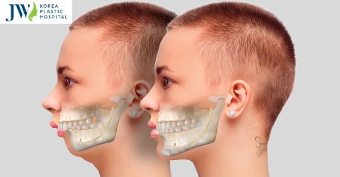 Phẫu thuật hàm hô có nguy hiểm không? Hãy đọc ngay