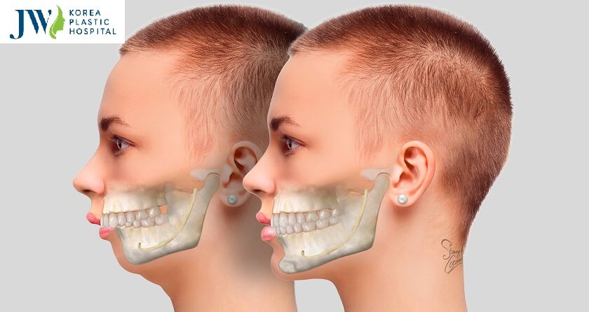 Phẫu thuật hàm hô có nguy hiểm không? Hãy đọc ngay