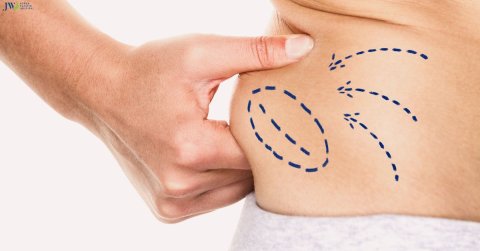 Quy trình chăm sóc bệnh nhân hút mỡ bụng toàn bộ