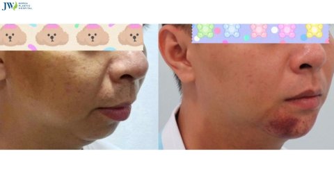 Quy trình chăm sóc bệnh nhân sau phẫu thuật tạo hình cằm (ASO)