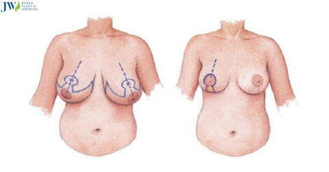 Quy trình chăm sóc bệnh nhân phẫu thuật treo tuyến 2 vòng