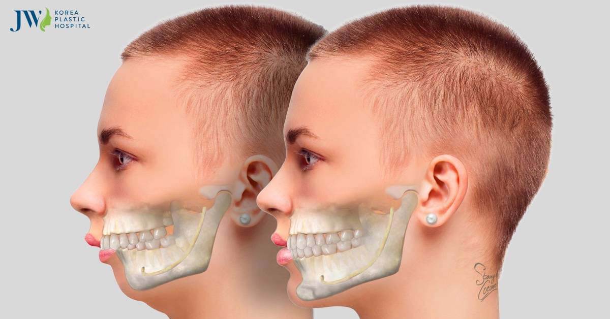 Quy trình chăm sóc phẫu thuật chỉnh hàm móm BSSO