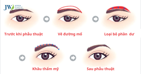 Quy trình chăm sóc bệnh nhân treo cung mày