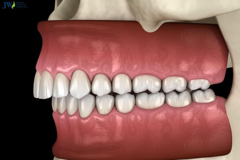 Niềng răng trong suốt AI có điều trị răng hô hàm trên được không? 1