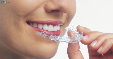 Niềng răng trong suốt AI: Khái niệm, cách hoạt động và điểm khác biệt