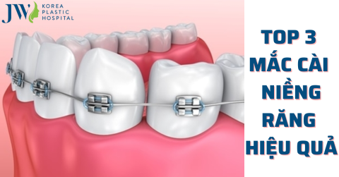 Các loại mắc cài niềng răng mang lại hiệu quả ngày nay